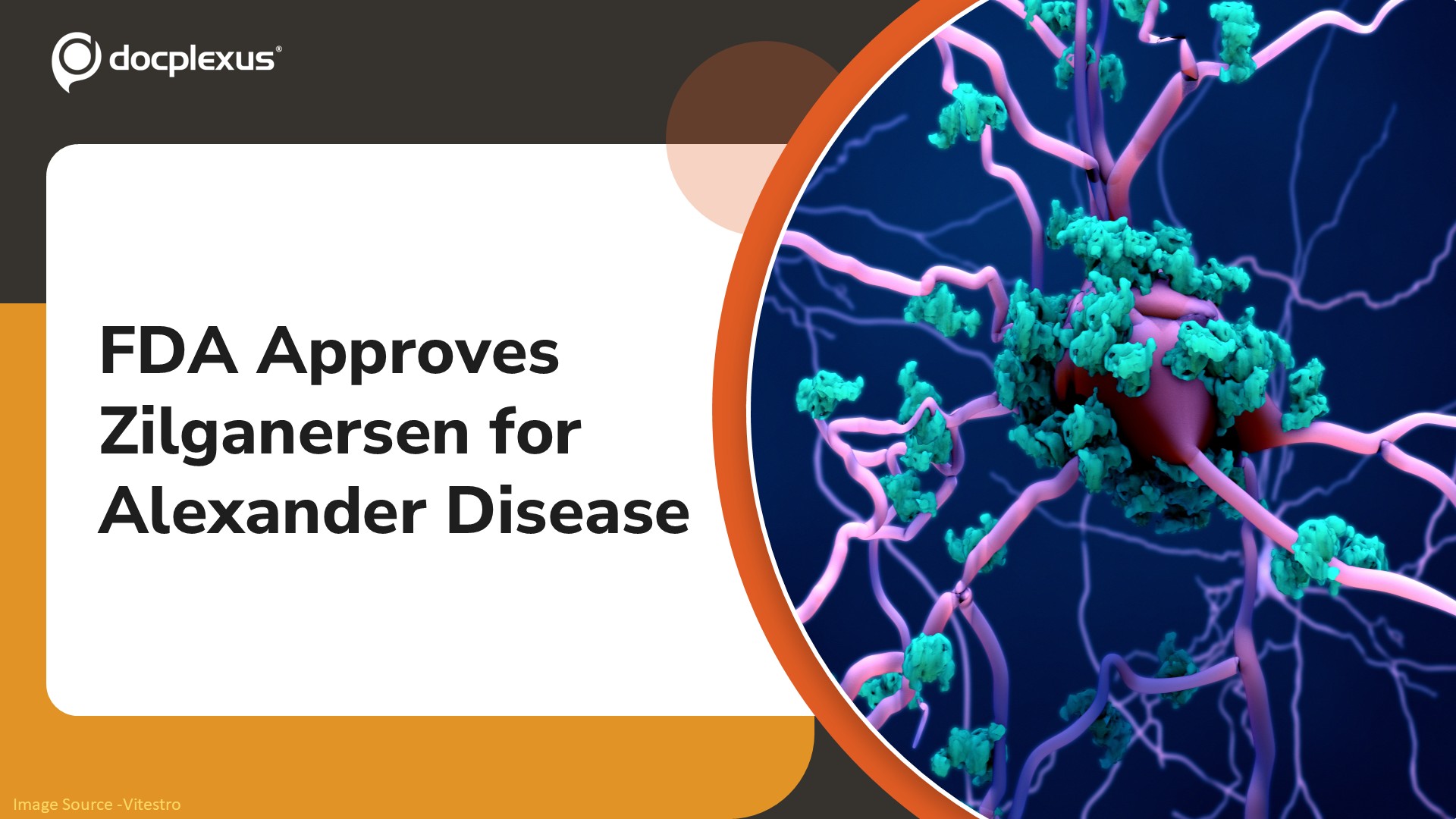 FDA Approves Zilganersen (Zanvastro) for Alexander Disease