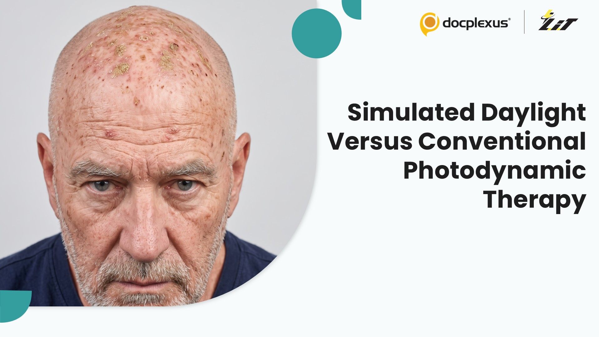 Simulated Daylight Versus Conventional Photodynamic Therapy for Actinic Keratoses