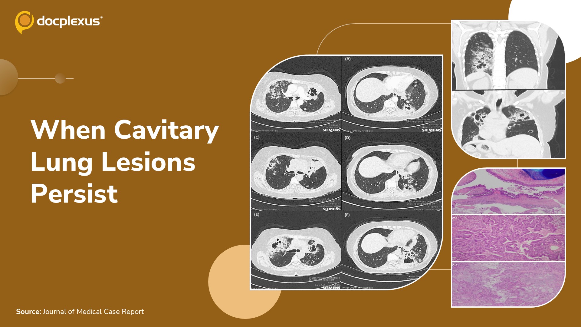 Progressive Cavitary Lung Lesions: Can You Identify the Cause?