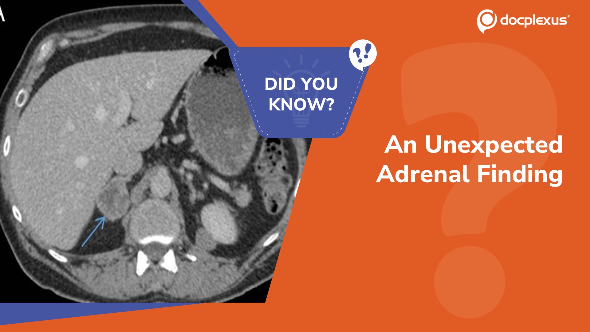 Image Challenge: What Is the Diagnosis Behind This Adrenal Mass?