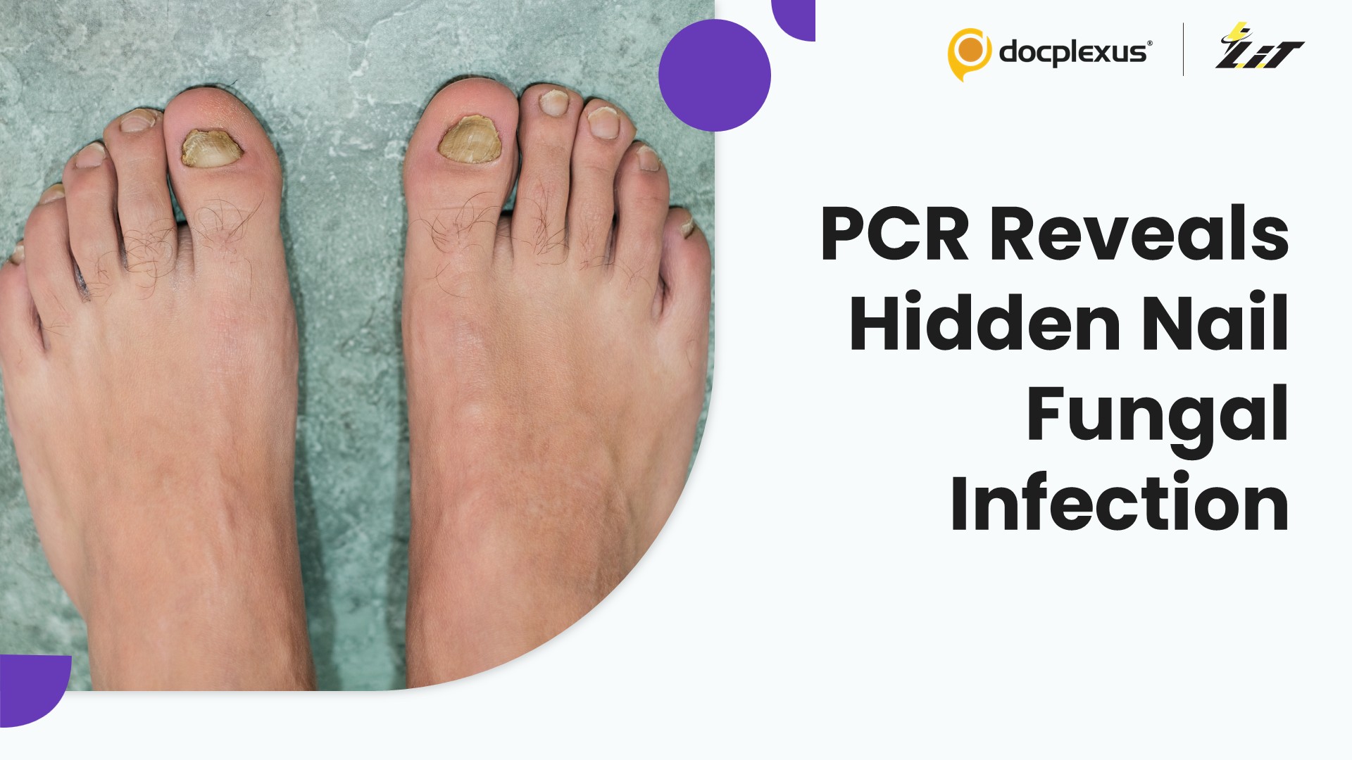 PCR Detects Subclinical Nail Dermatophytes in Patients With Skin Dermatophytosis