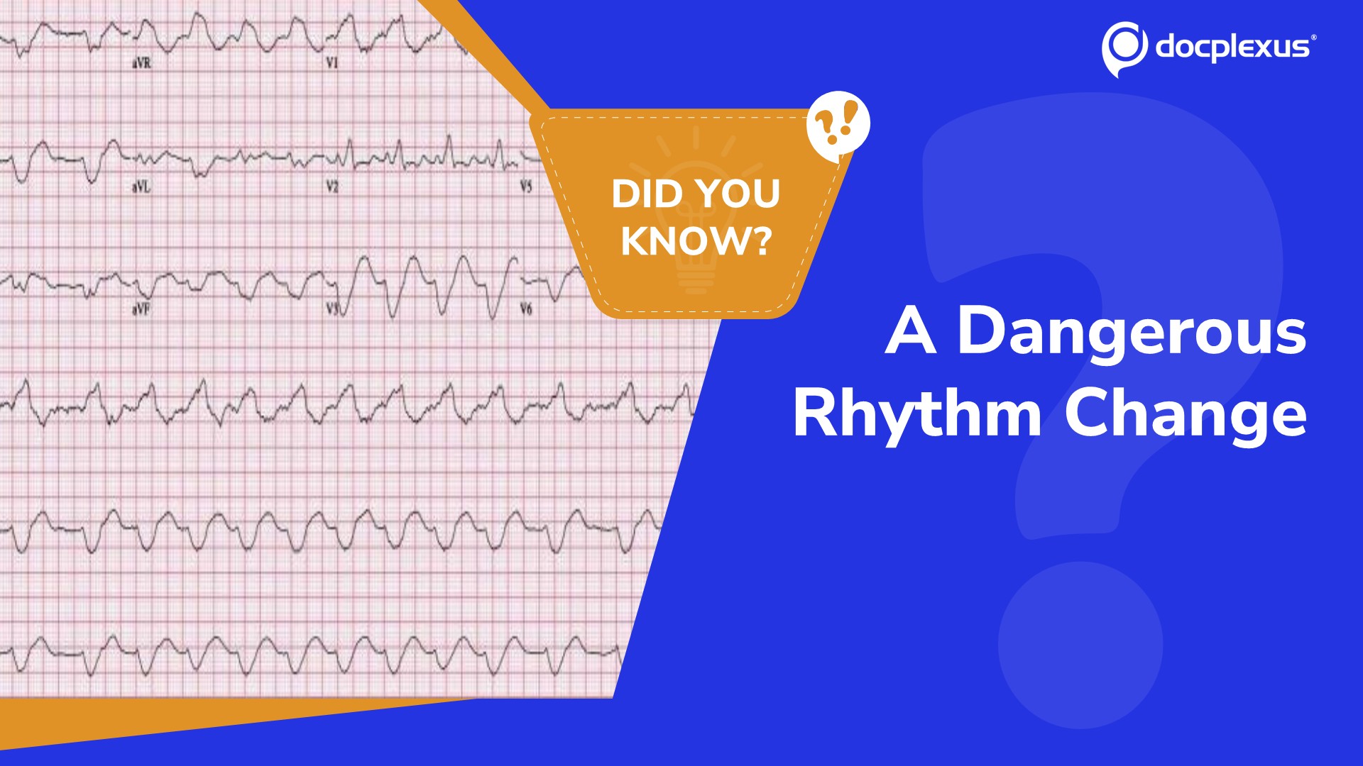What Does This ECG Indicate?