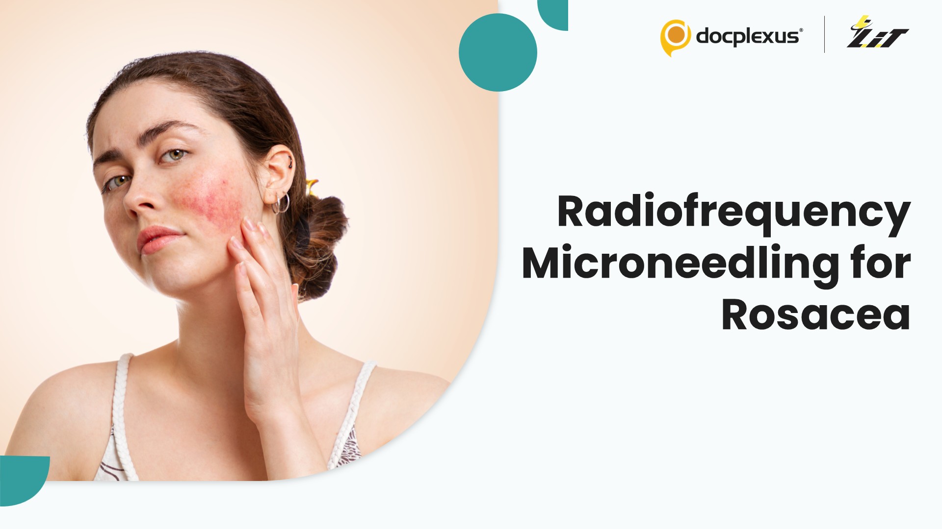 Radiofrequency Microneedling for Rosacea: Real-World Clinical Outcomes