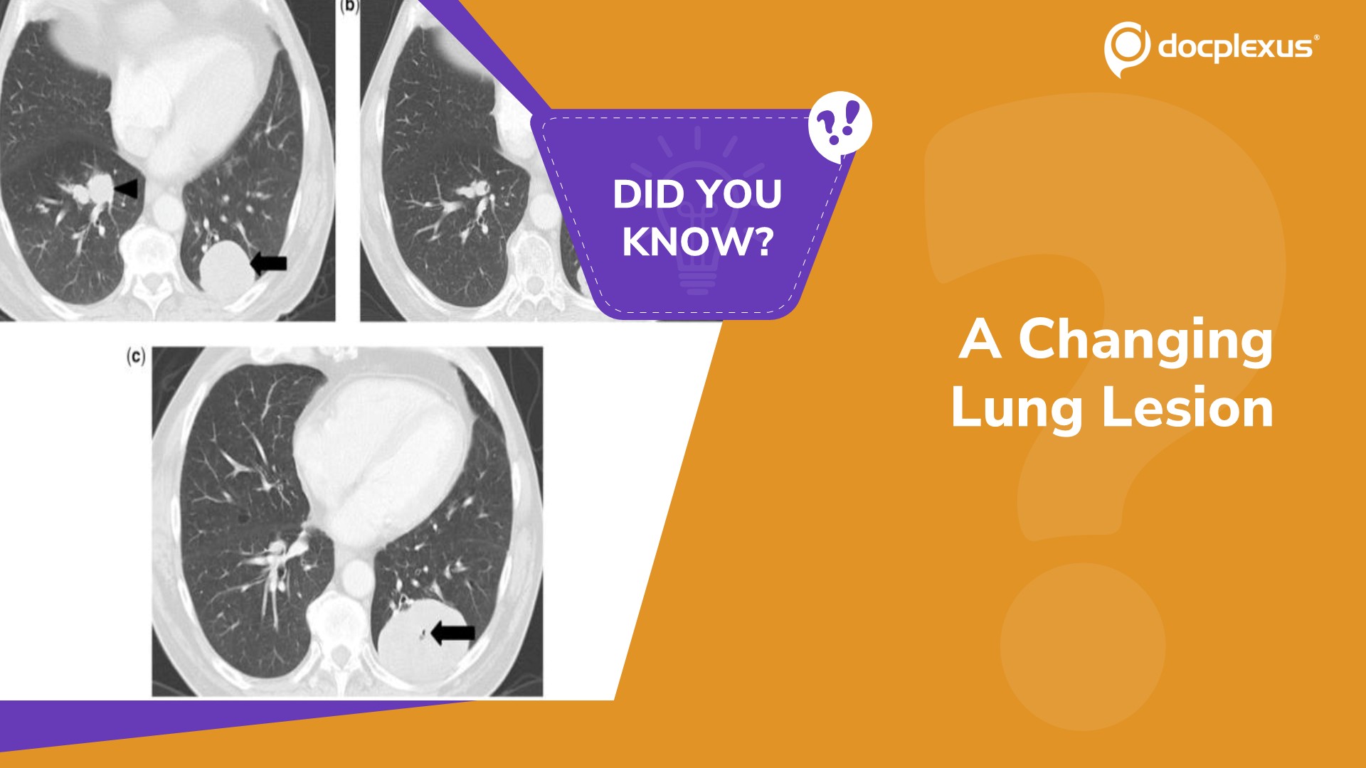 What Does This Change on Follow-Up CT Suggest?