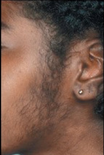 Excessive Facial Hair In A Young Woman