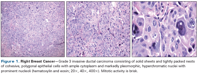 Case Of Synchronous Bilateral Breast Cancer With Conflicting Histology