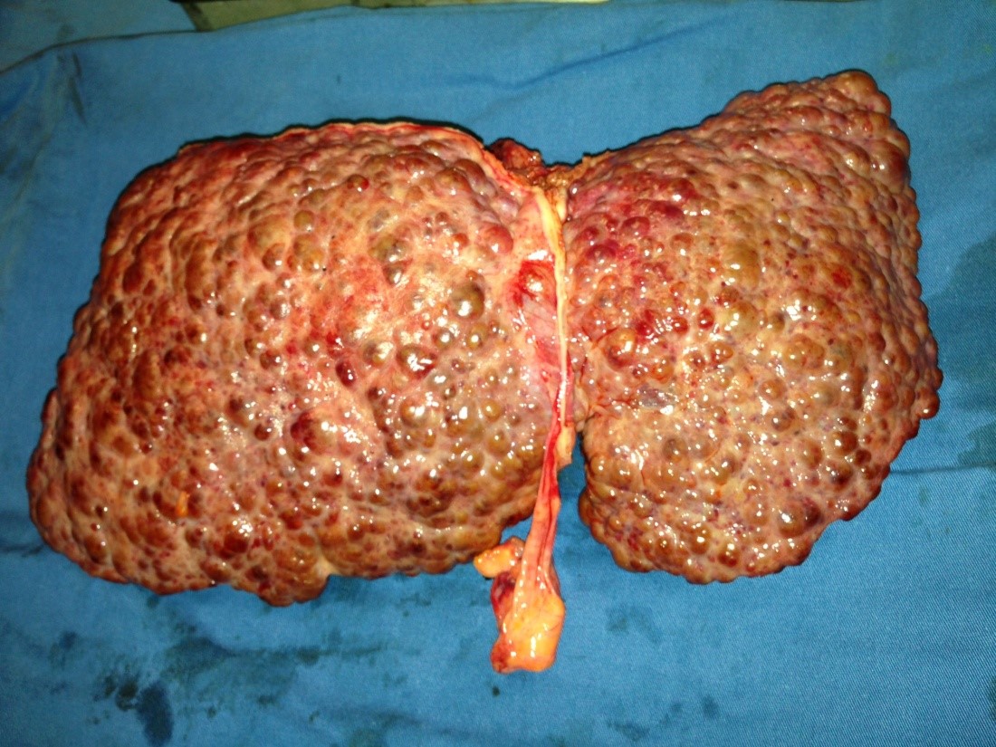Diabetes Mellitus in Liver Transplantation