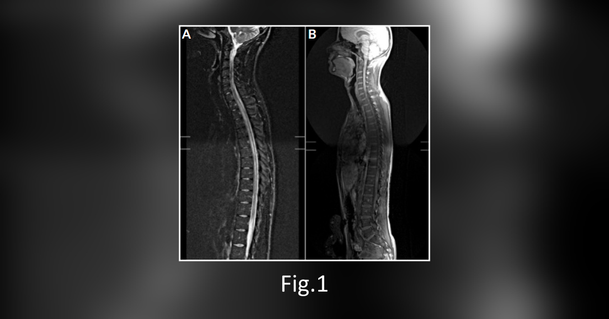 A Rare Case of Acute Disseminated Encephalomyelitis (ADEM) With EBV Infection