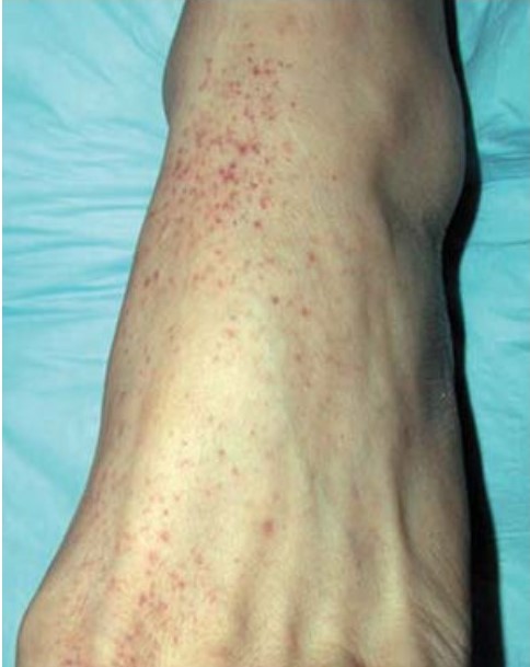 A Teenager with Lethargy and Headache