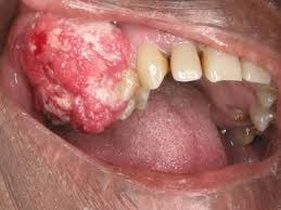 Early Diagnosis of Oral Carcinoma: Catch Them in the Bud