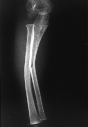 Identify The Type Of Fracture