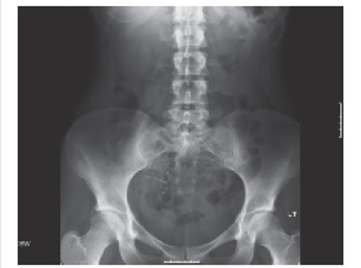 Investigate The Case OF Pain And The Intrauterine System