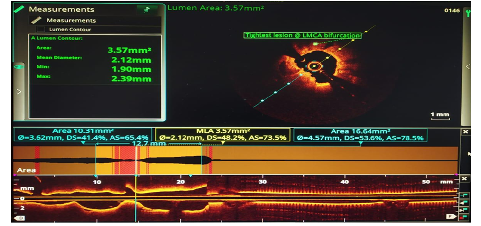 A LMCA-CABG Case