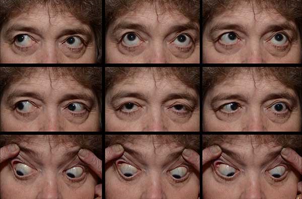 Identify The Ophthalmic Condition