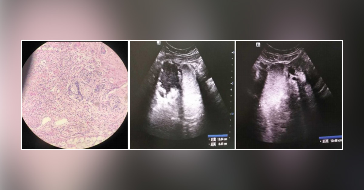 A Case of Recurrent Teratoma