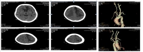 Case-based: Stroke Patient In Aortic-stenosis- What To Do?