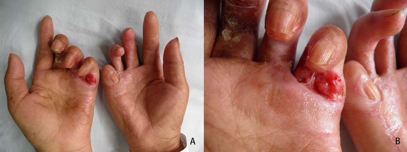 Identify the Pathological Reason Behind These Skin Lesions