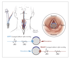 Laryngeal And Vagus Nerve Monitoring, A Novel Technique